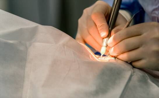 Laserowe zamykanie naczyń: co warto wiedzieć przed zabiegiem