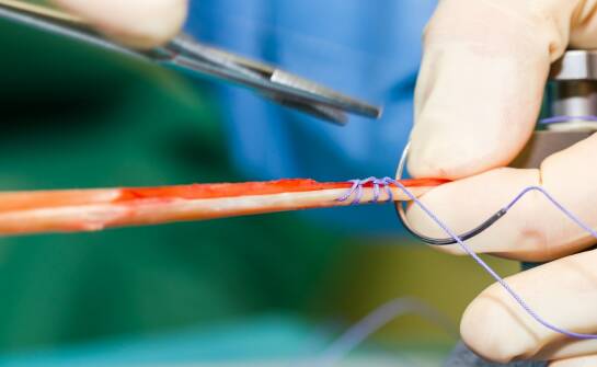 Skleroterapia żył — co warto wiedzieć przed zabiegiem i jakie są efekty