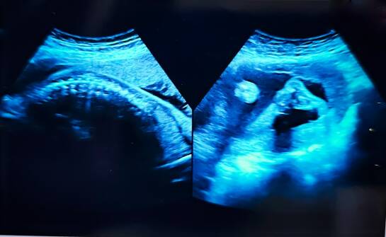 Tomografia plamki żółtej: co warto wiedzieć o badaniu i wynikach