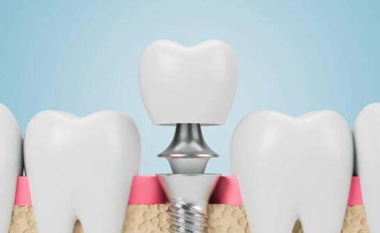 Jak przebiega kwalifikacja do implantu i co warunkuje jego integrację z kością
