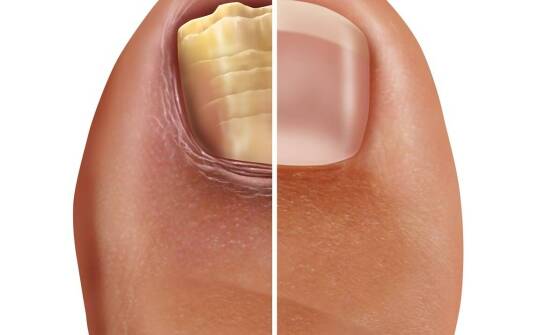 Jak rozpoznać grzybicę paznokci i odróżnić ją od urazu lub przesuszenia