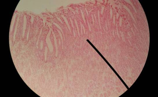 Biopsja i histopatologia — co naprawdę mówi wynik przed leczeniem nowotworu układu pokarmowego