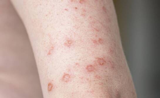 Nawracające zmiany skórne, świąd i łuszczenie — kiedy potrzebna jest ocena dermatologa
