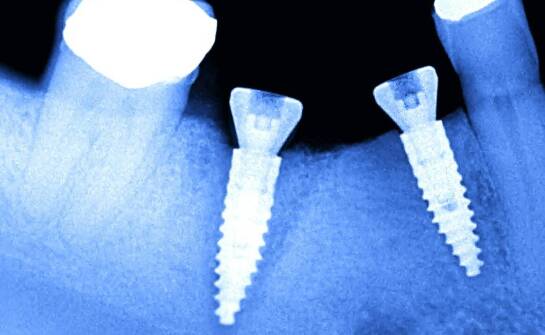 Jak tomografia i wywiad medyczny kwalifikują do odbudowy zębów na implantach tego samego dnia
