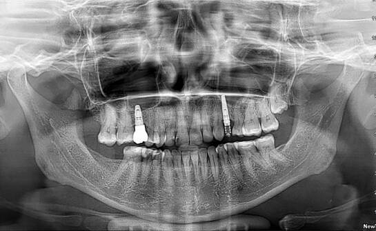 Co decyduje o kwalifikacji do implantu i późniejszej odbudowy zęba
