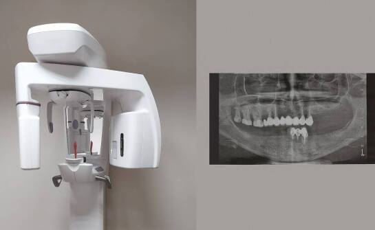 Kiedy panoramiczne zdjęcie zębów wystarcza przed leczeniem, a kiedy trzeba przejść do tomografii 3D