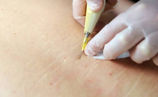Kiedy mikronakłuwanie i karboksyterapia mają sens przy redukcji blizn