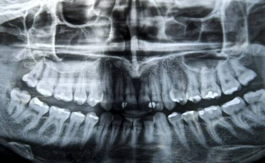 Jakie warunki w jamie ustnej decydują, czy implant może zastąpić brakujący ząb