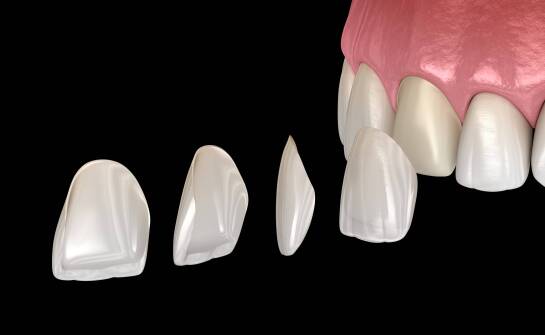 Licówki kompozytowe i porcelanowe — czym różnią się pod względem wskazań i przygotowania zębów