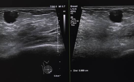 Kiedy ultrasonografia piersi pomaga wyjaśnić niepokojący objaw i co pokazuje