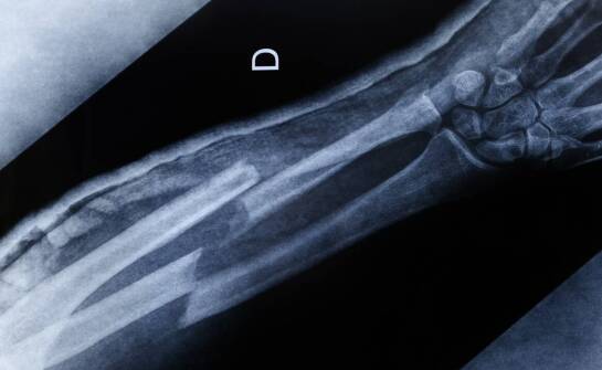 Badanie nadgarstka po urazie — kiedy ultrasonografia coś wyjaśnia