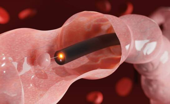 Kiedy angioplastyka tętnic kończyn może zastąpić operację otwartą