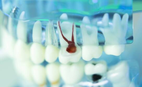 Jak materiały używane w endodoncji wpływają na szczelność i trwałość leczenia kanałowego