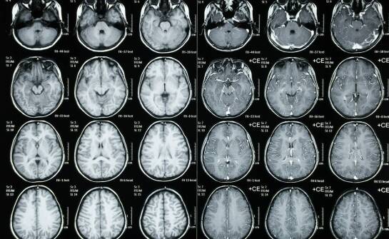Kiedy neurologiczne objawy wymagają konsultacji neurochirurgicznej i pilnej diagnostyki obrazowej