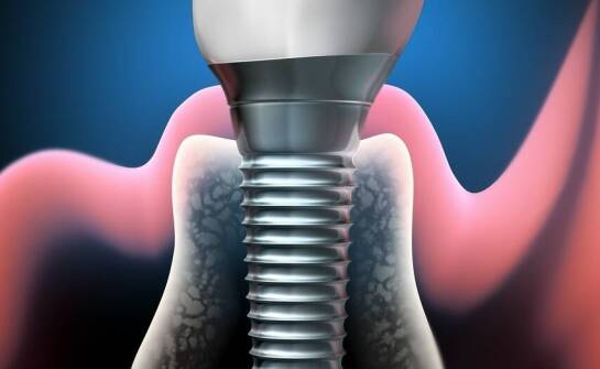 Pierwsze tygodnie po wszczepieniu implantu — co dzieje się z raną i kością