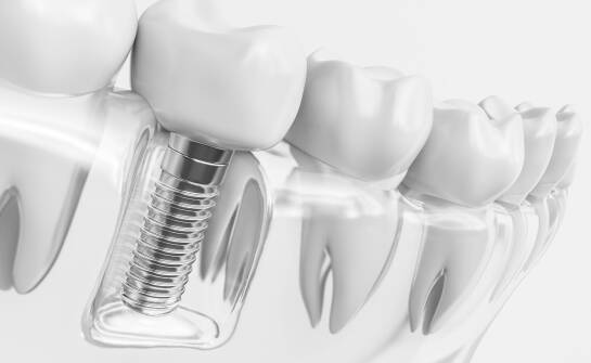 Kiedy odbudowa dna zatoki staje się warunkiem stabilnego wszczepienia implantu