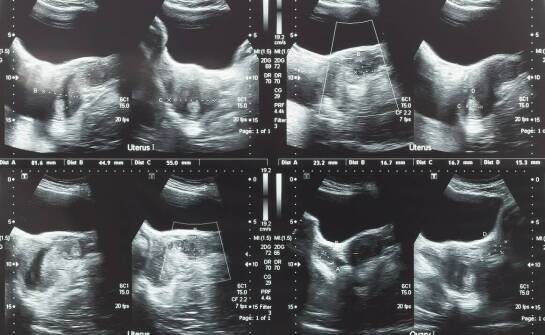 Endometrioza a trudności z zajściem w ciążę — jakie objawy i badania łączą oba problemy