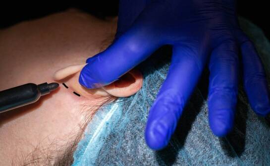 Kiedy odstające uszy kwalifikują do otoplastyki i jak przebiega gojenie po zabiegu