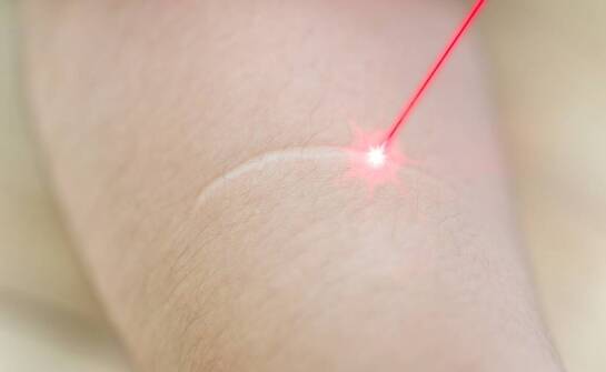 Co dzieje się z naczynkiem po zabiegu laserowym i jak goi się skóra