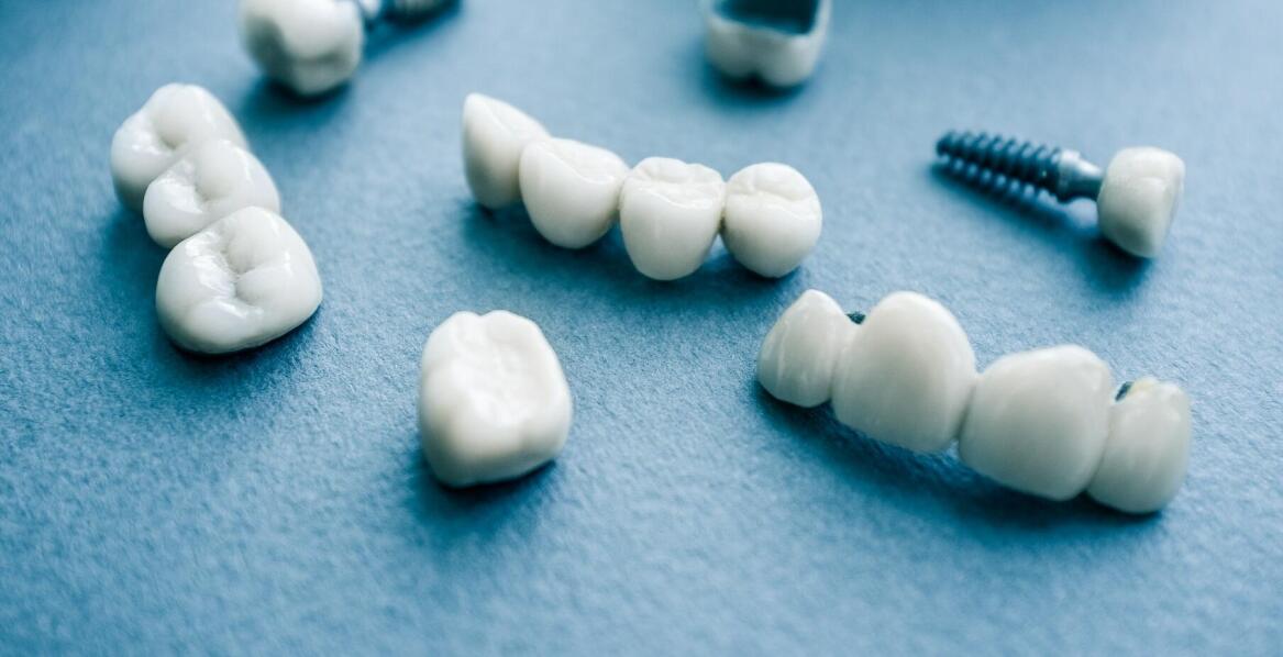 Alternatywy do implantów zębowych. Z czego można wybierać?