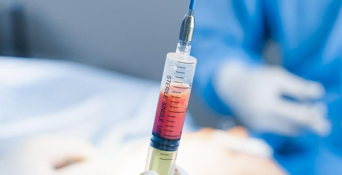 Czym jest lipofilling i kiedy warto zdecydować się na ten zabieg?