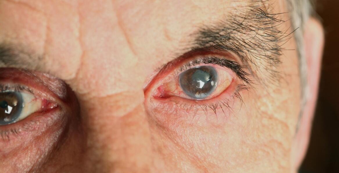 Czy leki są wystarczające, aby zatrzymać rozwój jaskry?