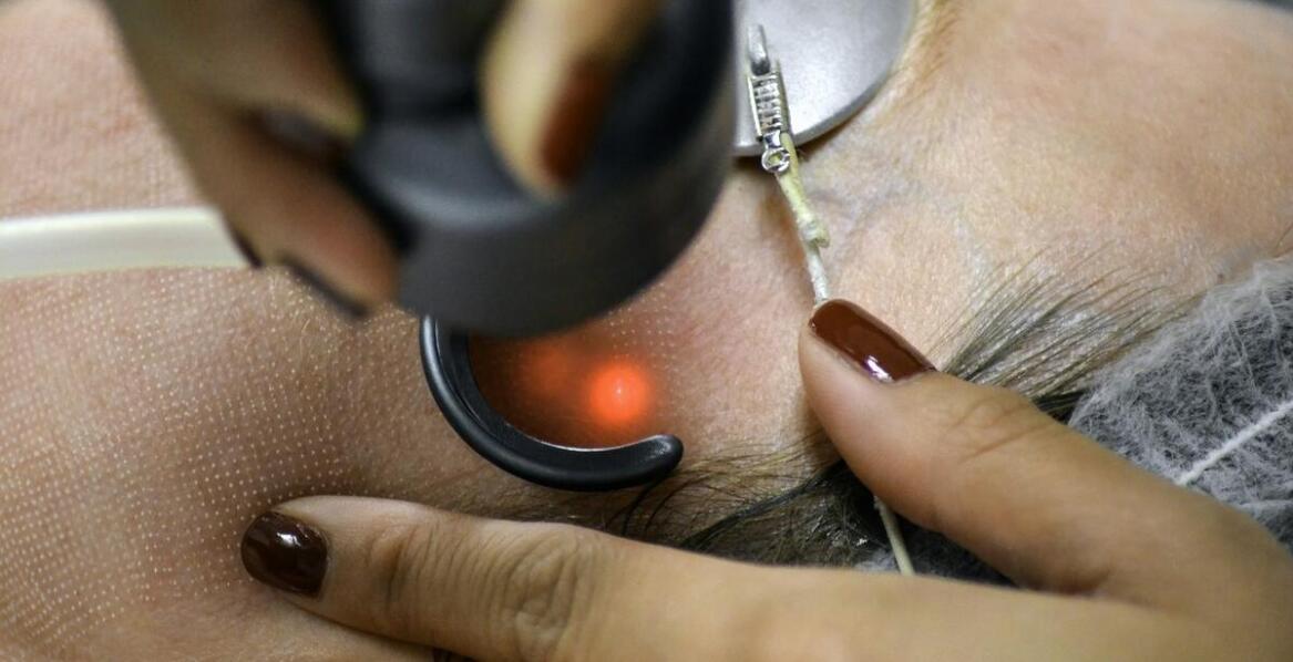 Porównanie różnych metod terapii trądziku: która jest najlepsza dla Ciebie?