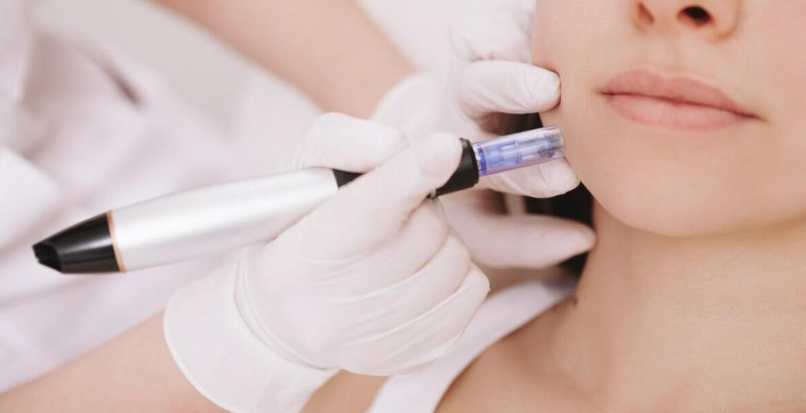 Jakie są korzyści z zabiegów Dermapen?