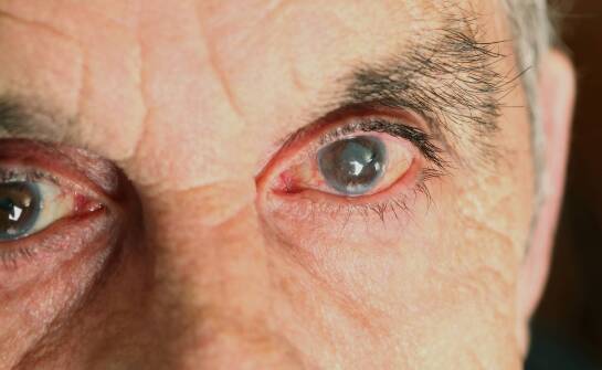 W jakim wieku najczęściej diagnozuje się jaskrę?