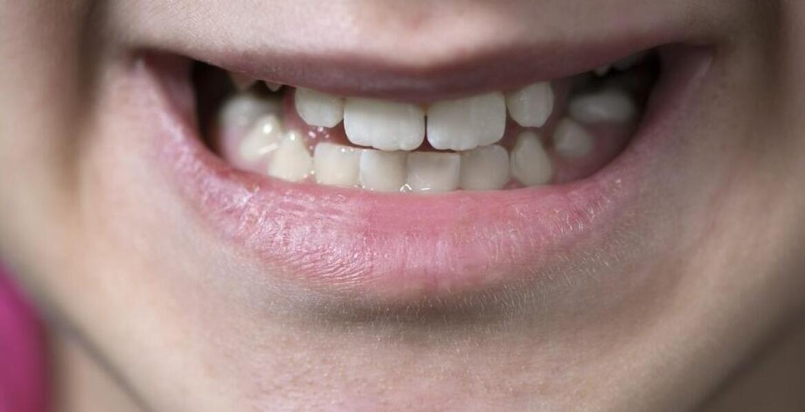 Jakie są objawy nieprawidłowej okluzji?