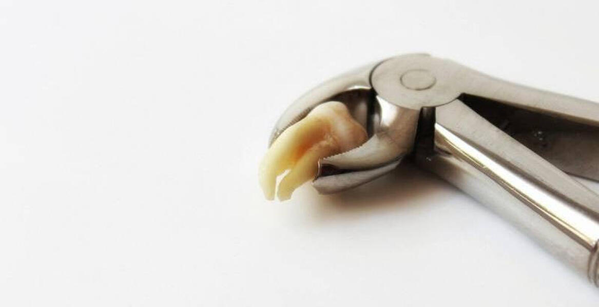 Wszystko na temat zakładania licówek w Warszawie z ceną