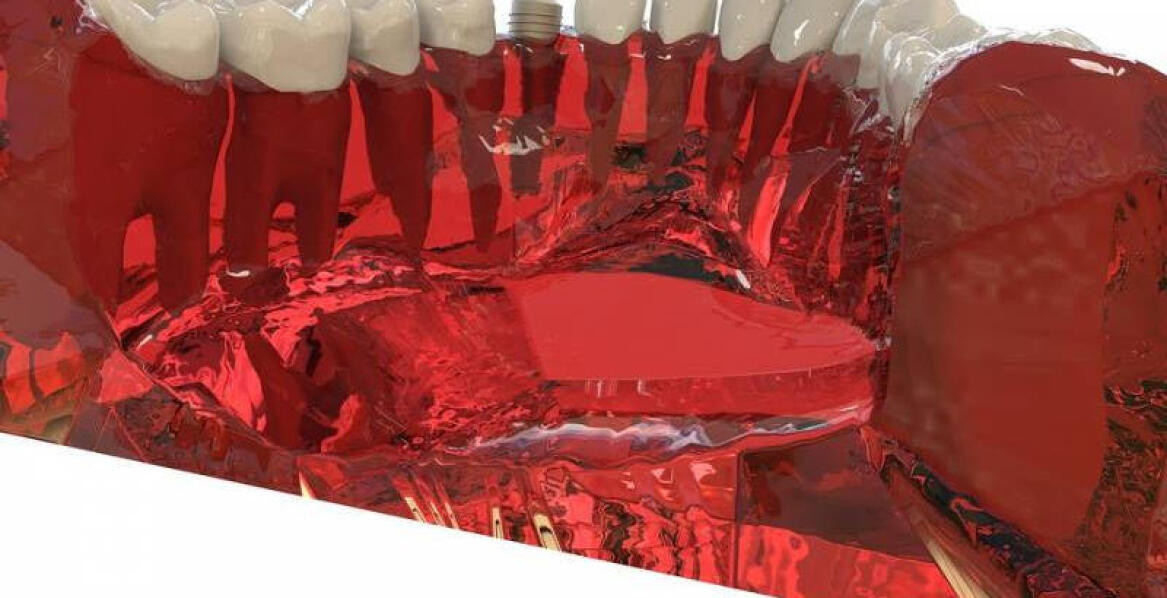 Najlepsze implanty zębowe w Kołobrzegu