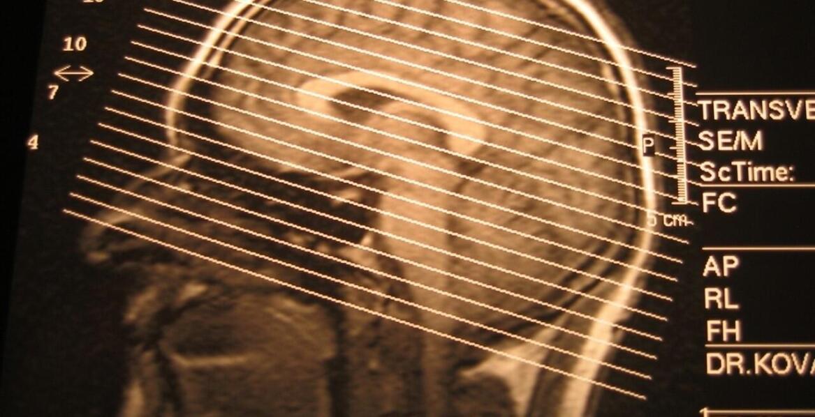 Opryszczkowe zapalenie mózgu