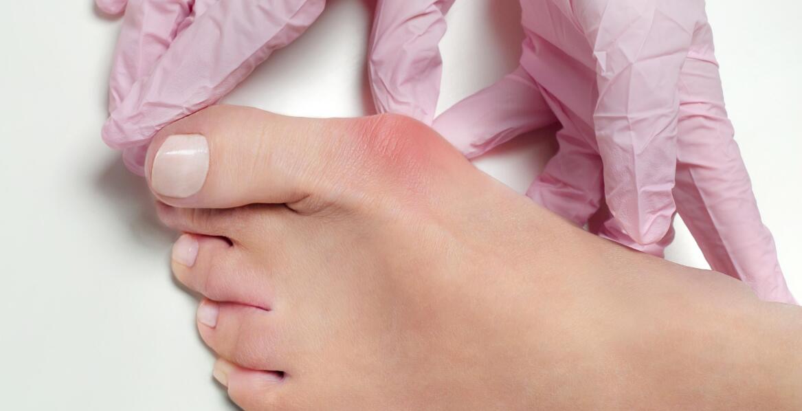 Czy po operacji haluksa trzeba przejść rehabilitację?