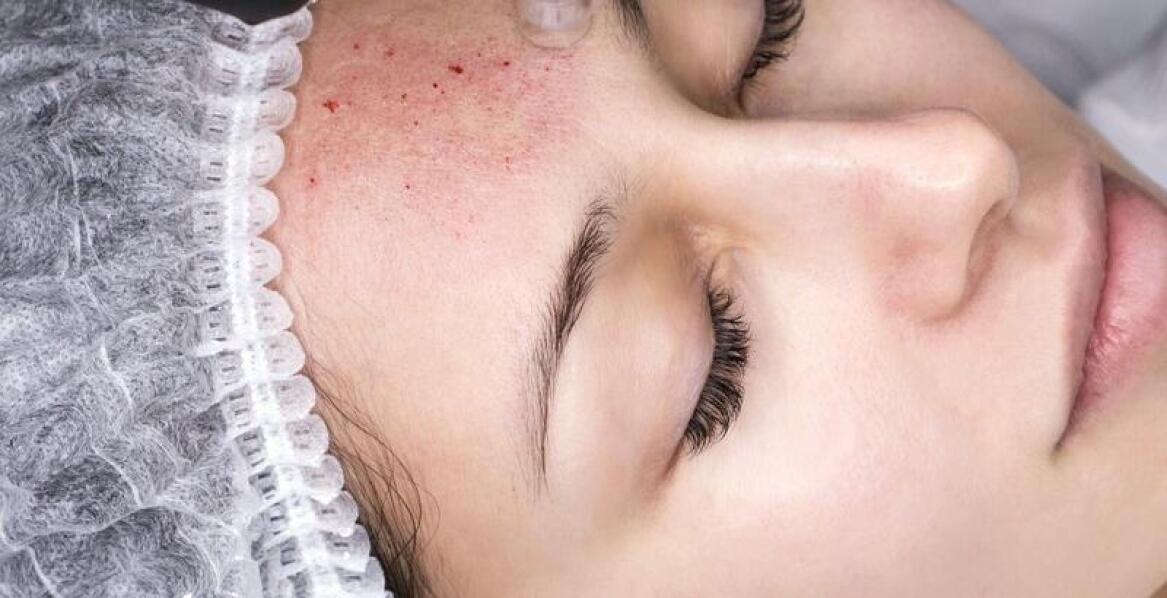 Osocze bogatopłytkowe jako sposób na poprawę kondycji skóry po 30-tce