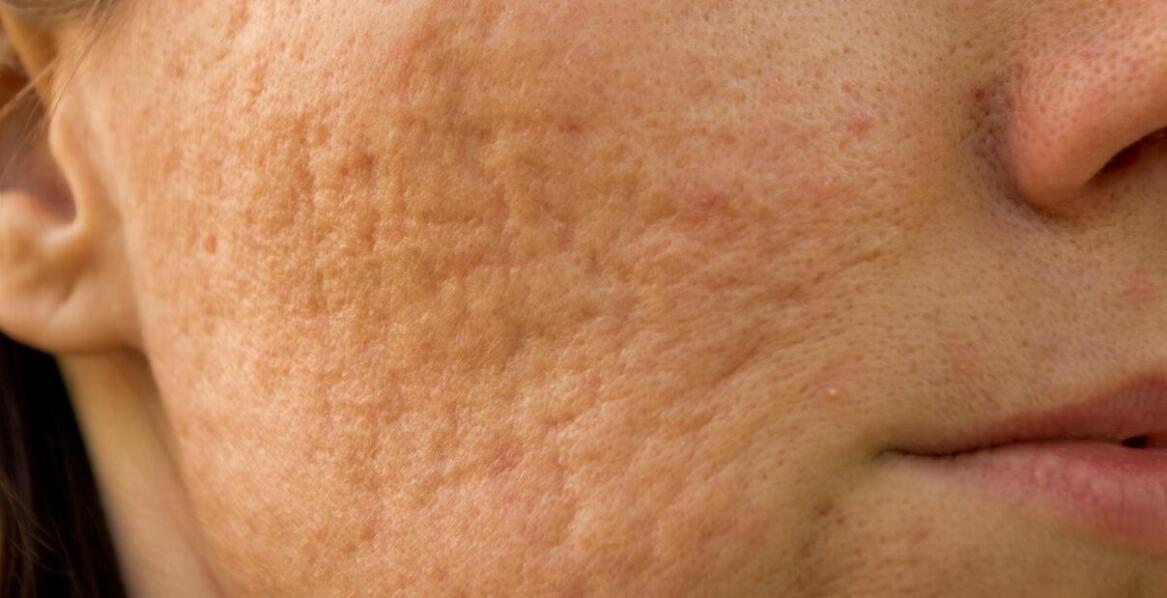 Jakie są etapy procesu usuwania blizn potrądzikowych?