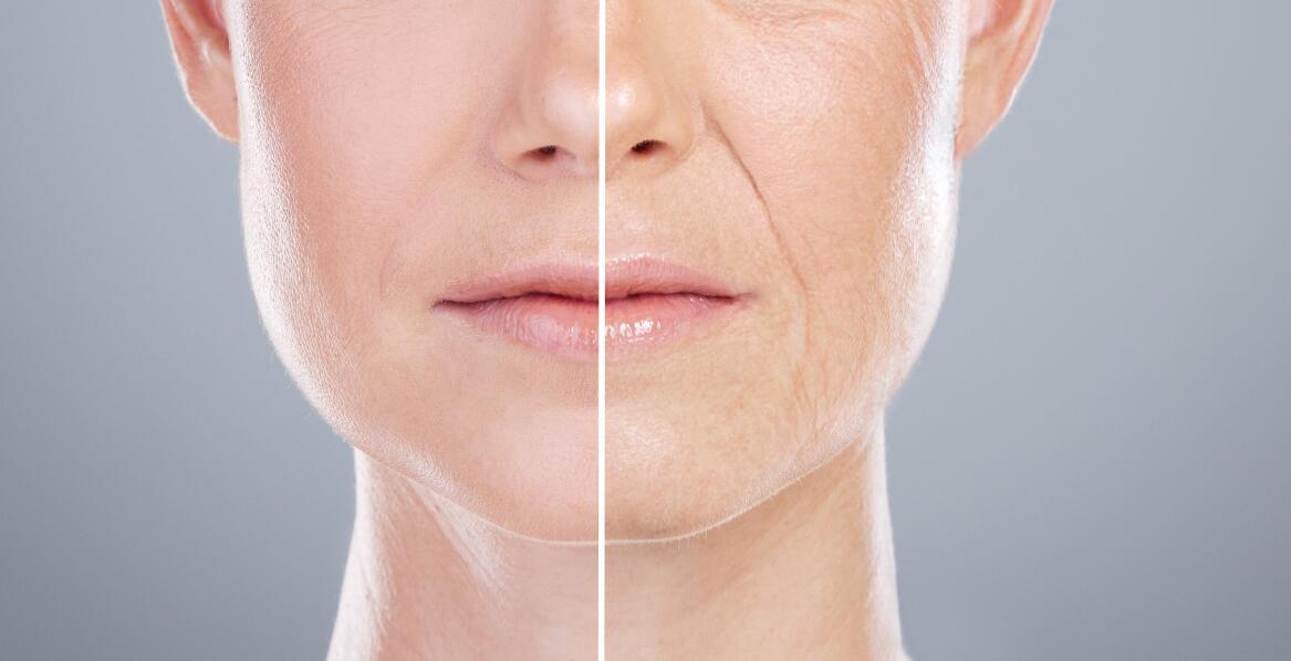 Lifting profhilo – klucz do naturalnego wyglądu bez operacji