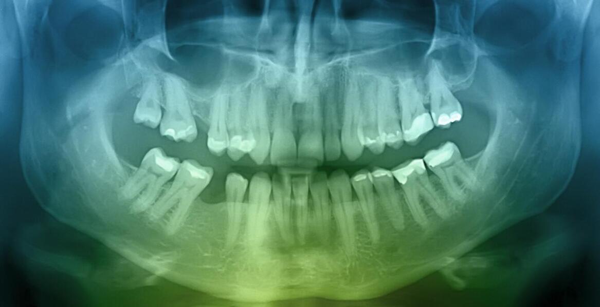 Rola tomografii 3D w planowaniu usuwania ósemek – jak pomaga w diagnostyce?