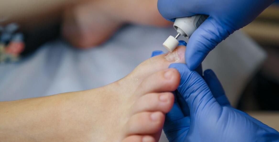 Najnowsze metody leczenia grzybicy stóp w gabinecie podologicznym