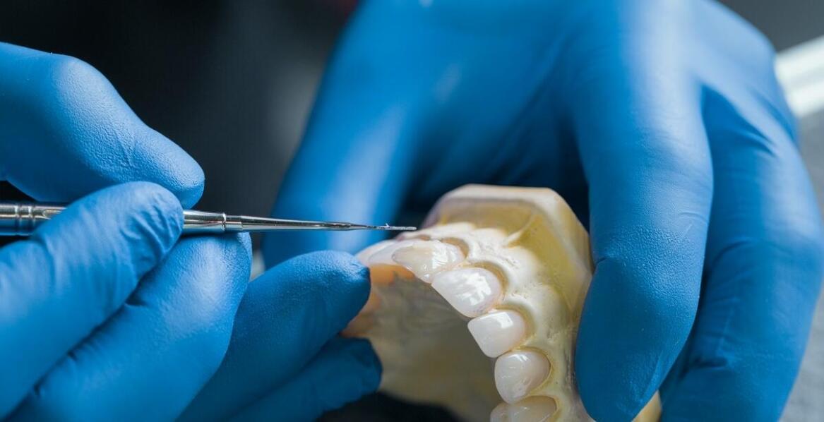 Jak cement dentystyczny wspiera rekonstrukcję zębów po leczeniu kanałowym?