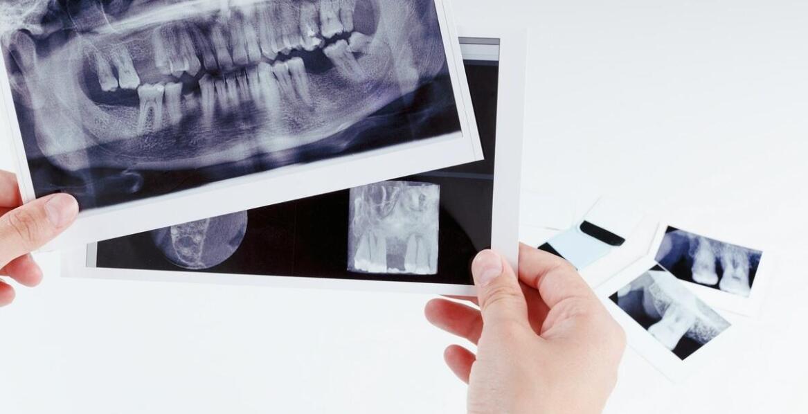 Zdjęcie rtg zęba a diagnostyka problemów z korzeniami – co warto wiedzieć?