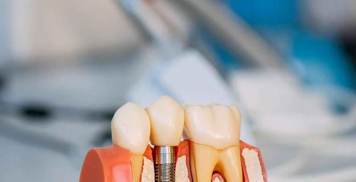 Jakie są najczęstsze błędy pacjentów podczas noszenia protez zębowych?