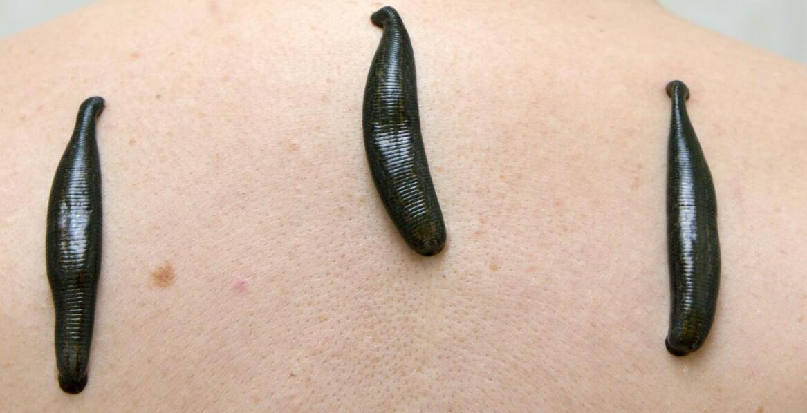 Hirudoterapia jako wsparcie w leczeniu nadciśnienia tętniczego