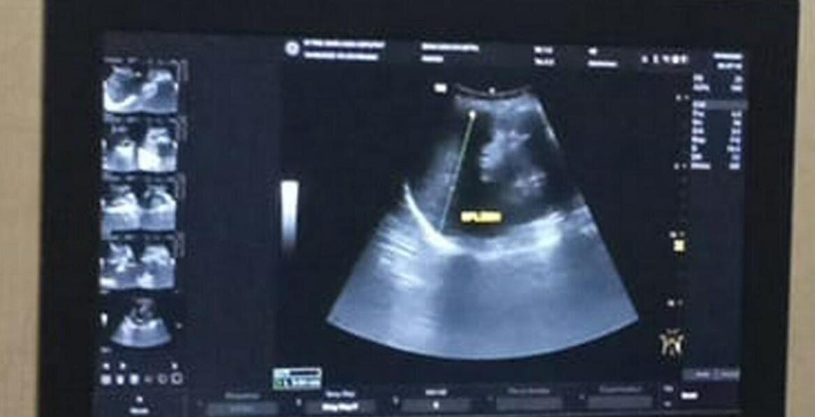 Zastosowanie ultrasonografii w diagnostyce chorób jąder