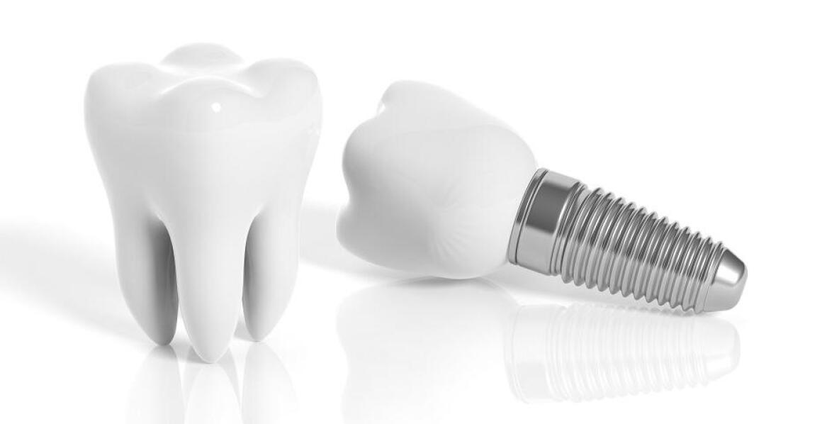 Wpływ wysokiej jakości materiałów na trwałość implantów zębowych