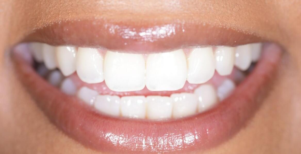 Jak implanty zębowe wpływają na estetykę uśmiechu?