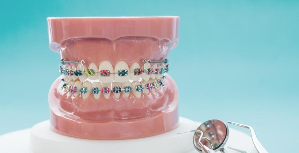 Co warto wiedzieć o procesie zakładania aparatu ortodontycznego?