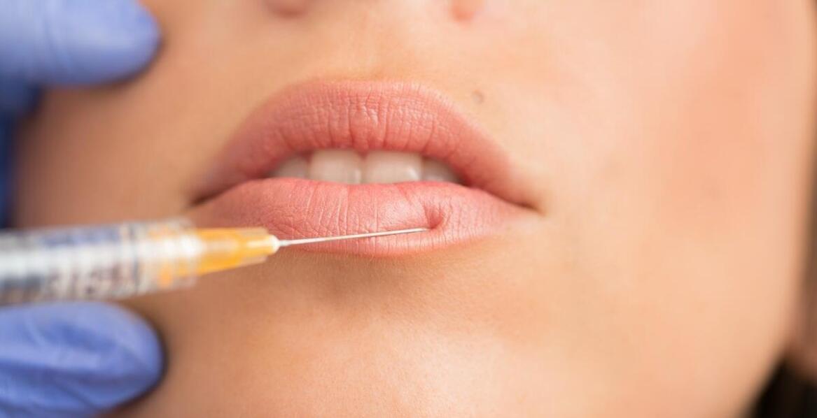 Powiększanie ust – krok po kroku przez proces zabiegu