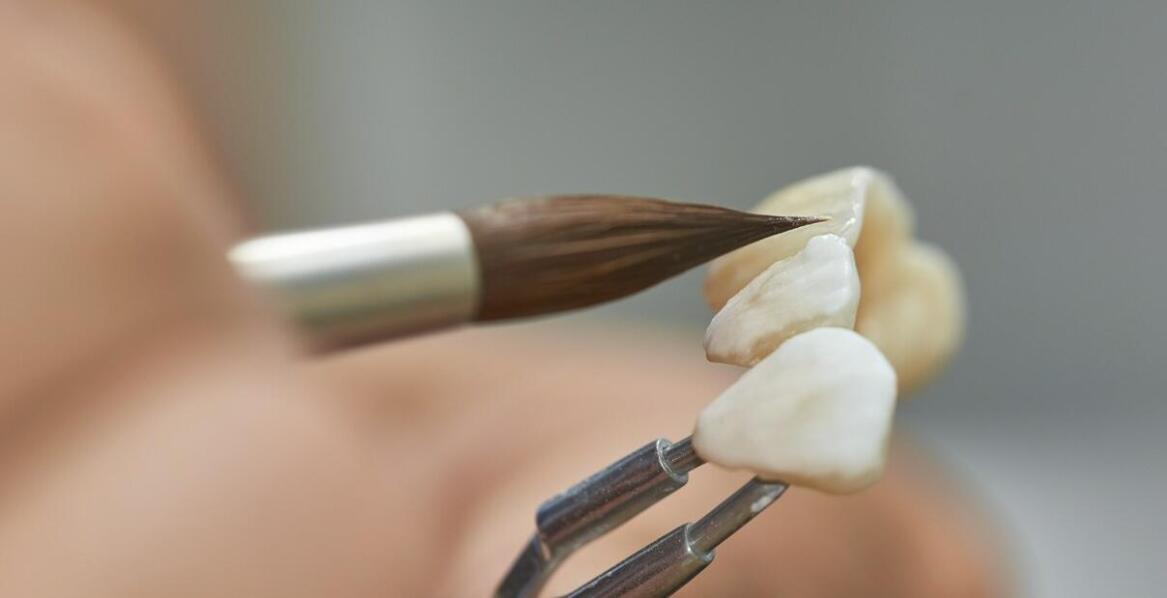 Jakie są różnice między tradycyjnymi a nowoczesnymi technikami zakładania licówek?