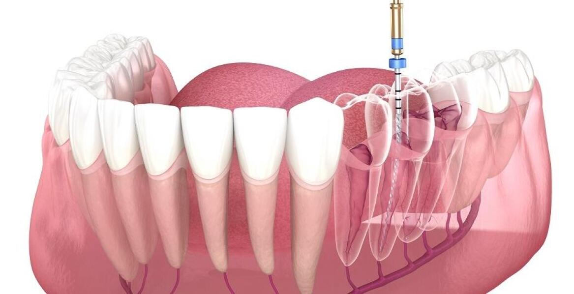 Jak dentysta dobiera odpowiednie leczenie endodontyczne?